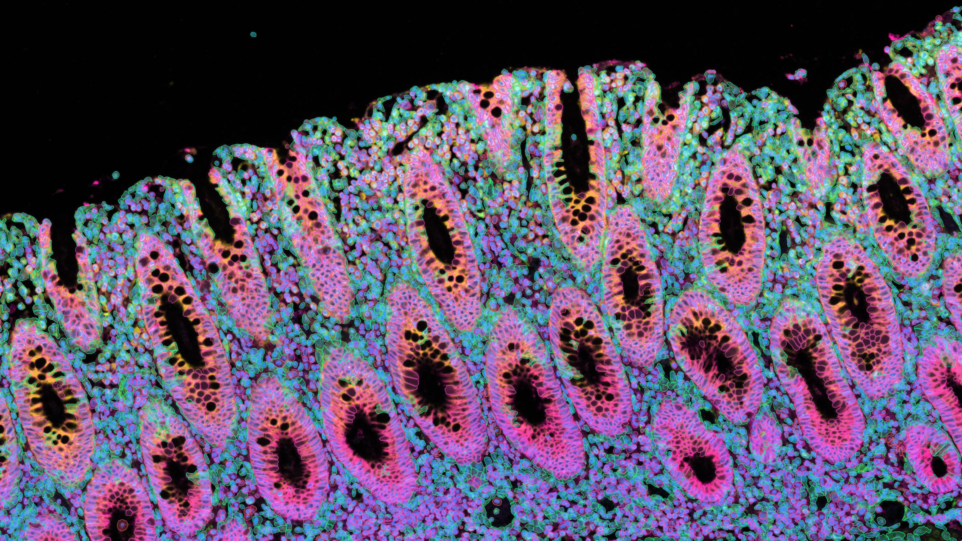Xenium data of human colon tissue