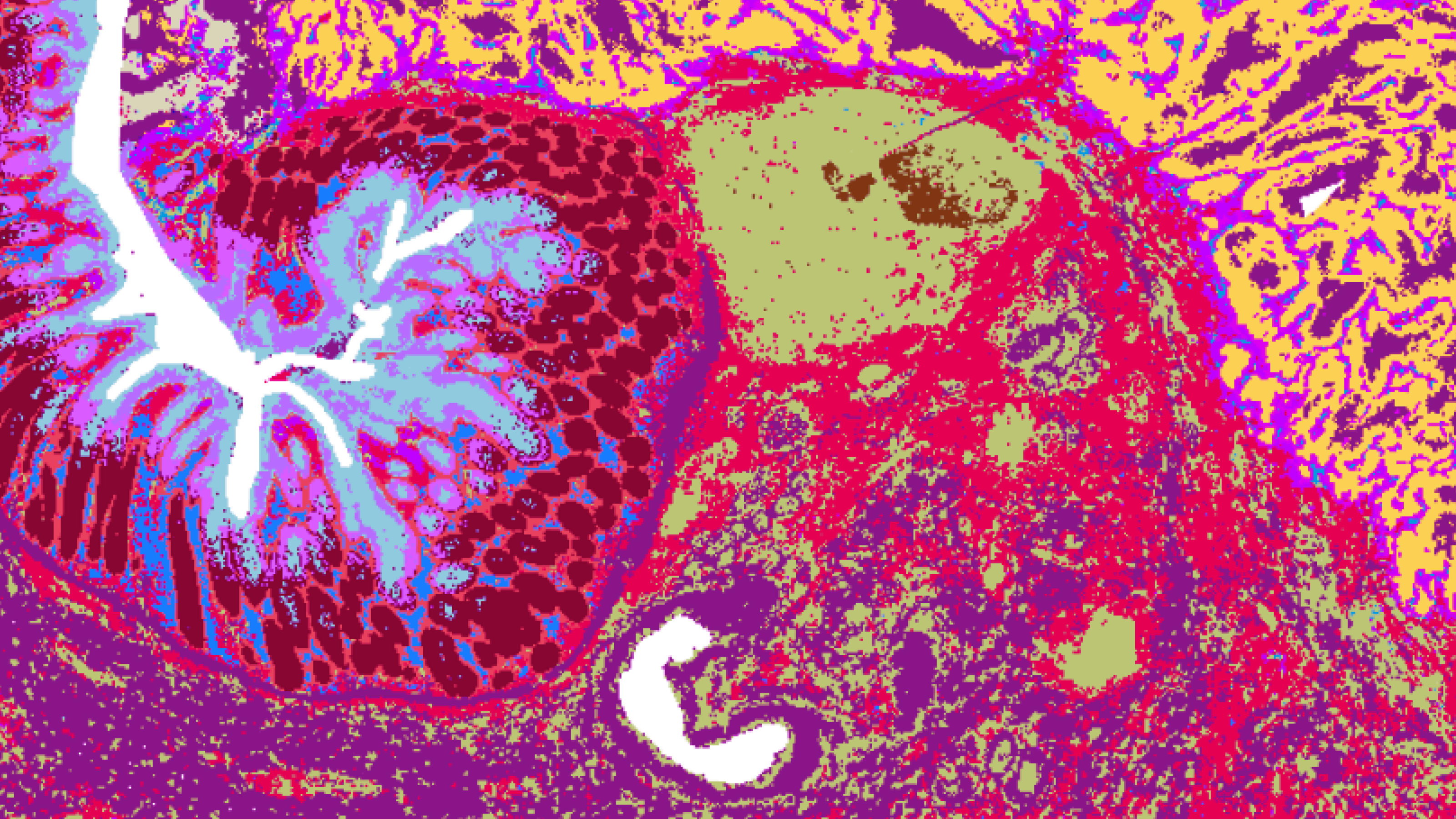 Visium HD data from human colon cancer tissue